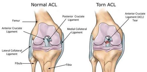 ACL Tear pic